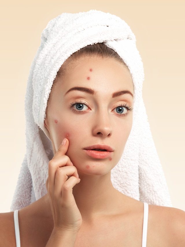Effective Ways To Control Acne